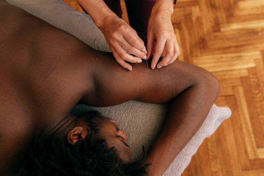 acupuncture on man laying down