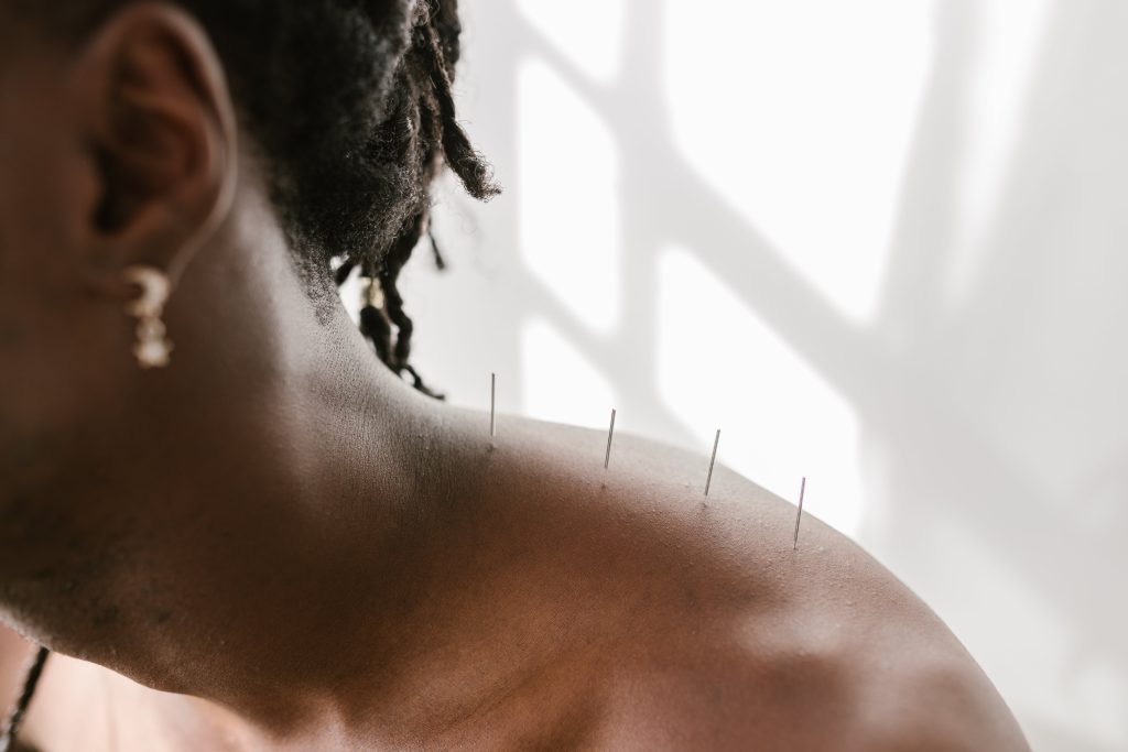 Acupuncture on persons shoulder