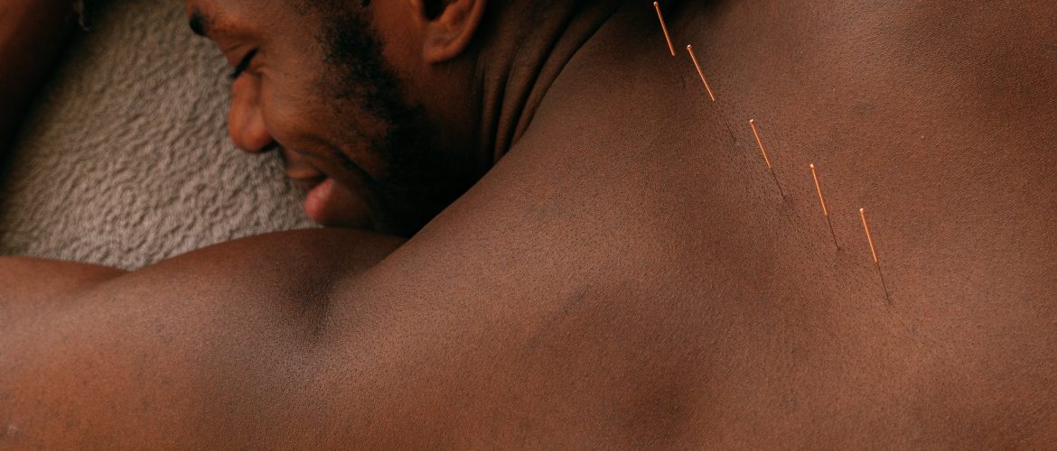 acupuncture needles in mans back laying down
