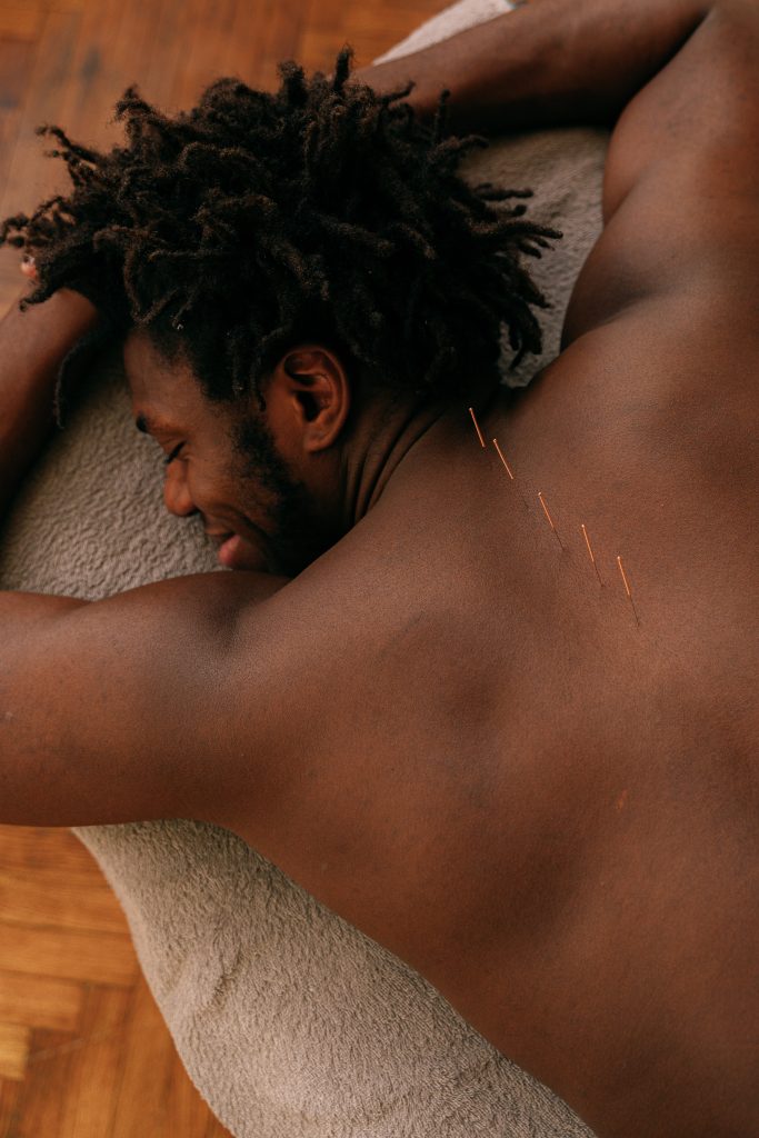 acupuncture needles in mans back laying down