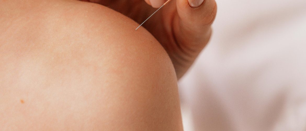 acupuncture needles placed on womans shoulder