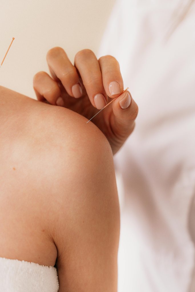 acupuncture needles placed on womans shoulder
